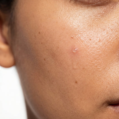 Blemish Spot Roller